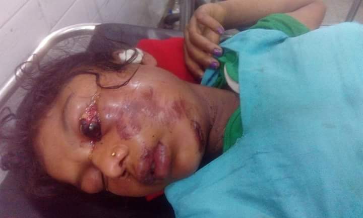भोजपुरमा एक बालिकालाई बलात्कार पछि आँखा नकालेर हत्या गर्ने प्रयास,उपचारमा डाक्टरको लापरबाही ।