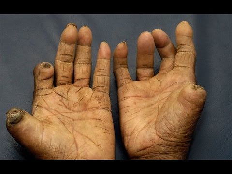 कुष्ठरोग उपचार विधि नै झन्झटिलो, लुकेर बस्छन् रोगी